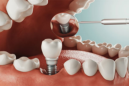 3D Rendering eines Zahns